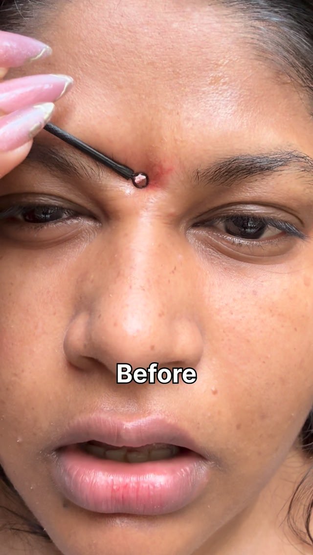 पूरा face acne से भर गया था but इस serum ने सब ठीक कर दिये  follow & Comment “ACNE” to get link 🔗 #foxtaleniacinamideserum #foxtale #foxtaleskin #foxtaleniacinamideclarifyingserum @foxtaleskin niacinamideserum bestserumf