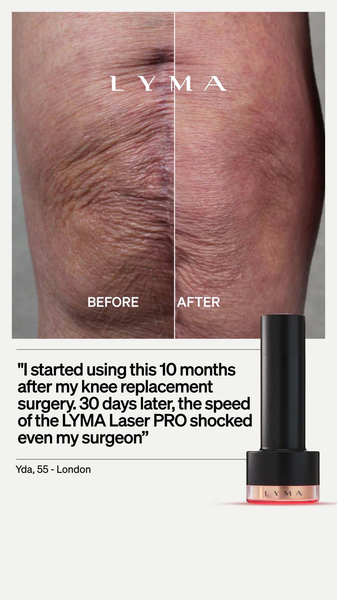 Scarring? Smoothed.