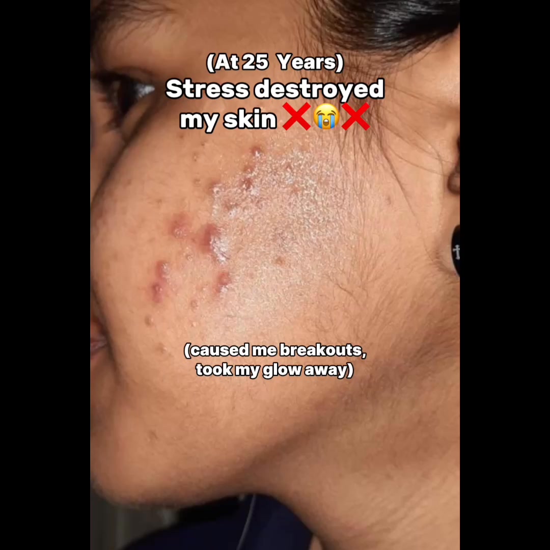 Stress Took A Toll On My Skin
