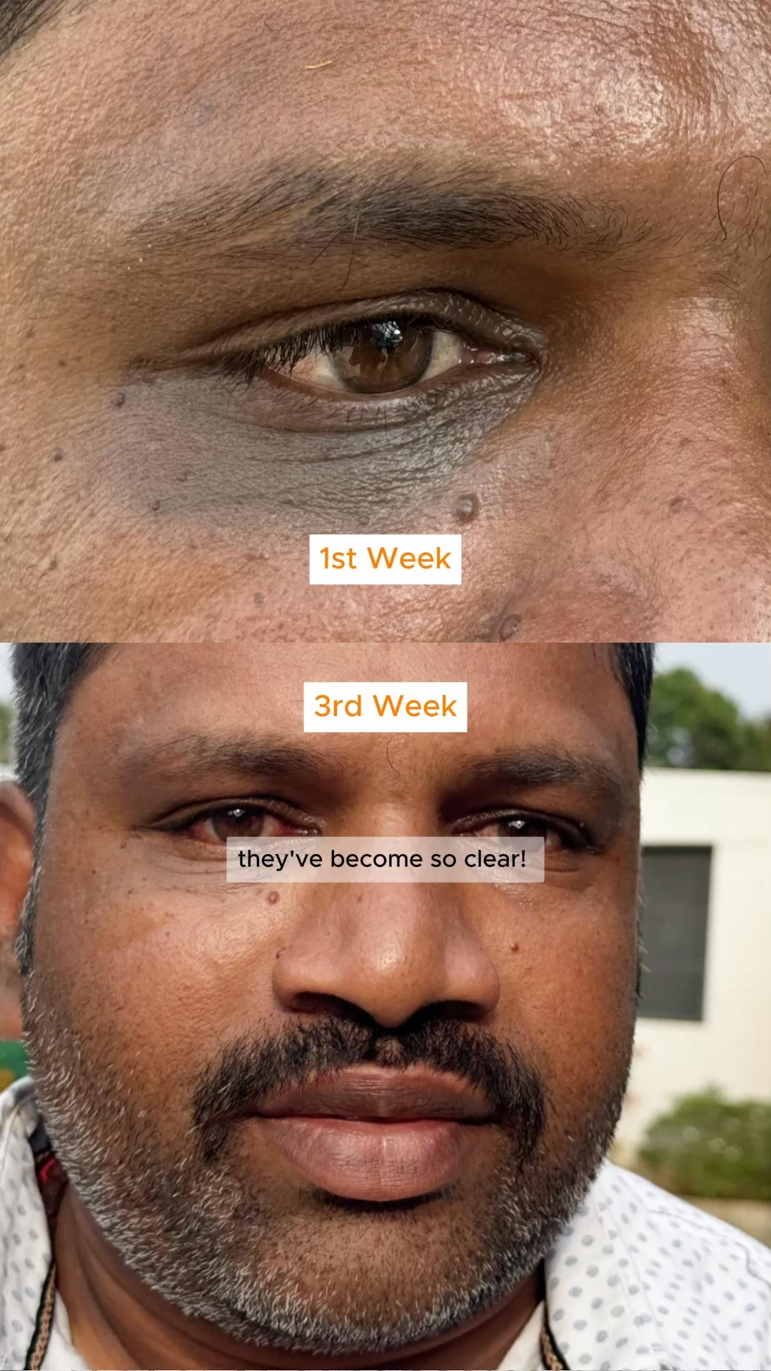 Brighter Under Eyes At Just ₹590!