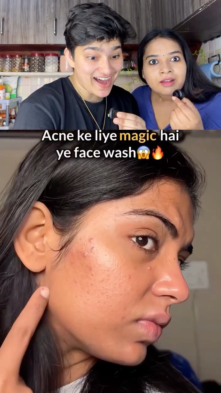 Comment for link 🔗 
If you also want acne and pimple free skin then must try this.
#skincare #beautyhacks #skincaretips #trending #reel