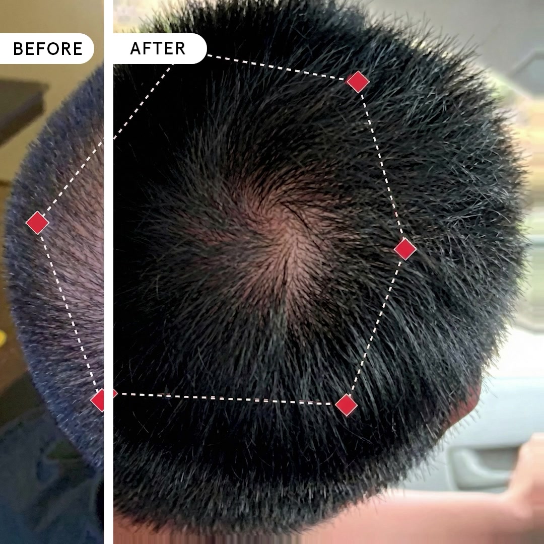 iRESTORE Hair Growth System