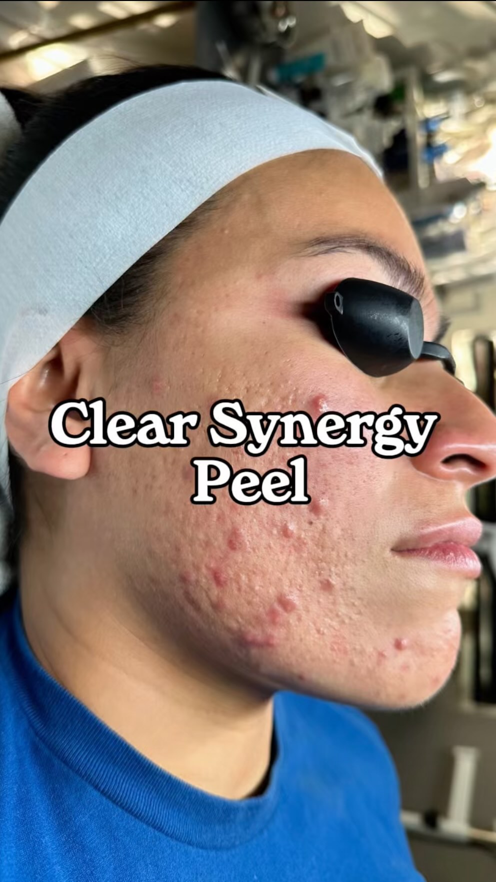 I’m so excited I can finally talk about this 😭👏🏽

I was selected to be part of a 3-month study with Face Reality for their NEW Clear Synergy Peel… and I knew exactly which client I wanted to put on it.

She’s been with m