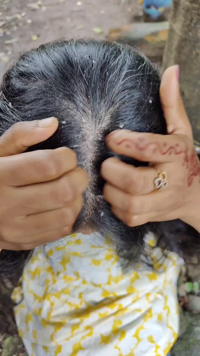 Comment for links💯💯തരാൻ മാറ്റാൻ ഇത് മാത്രം മതി 💯😍
@mamaearth.in 

#instagram #reelsinstagram #haircare #dandruff #trendingreels