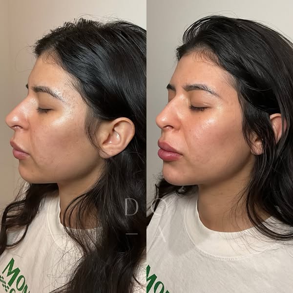 Chin Filler Creates a Dramatically More Snatched Jawline—Here’s What You Need to Know:

Chin filler is an advanced aesthetic treatment designed to refine the chin’s shape and enhance the firmness of the surrounding skin,