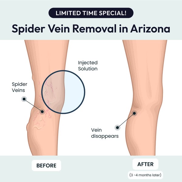 Vein Envy Meta ad creative