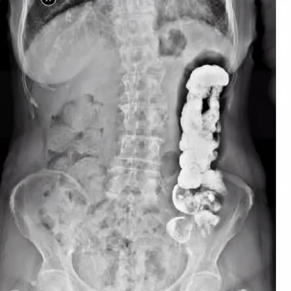 I Don't Treat Bloating. I Save Guts.