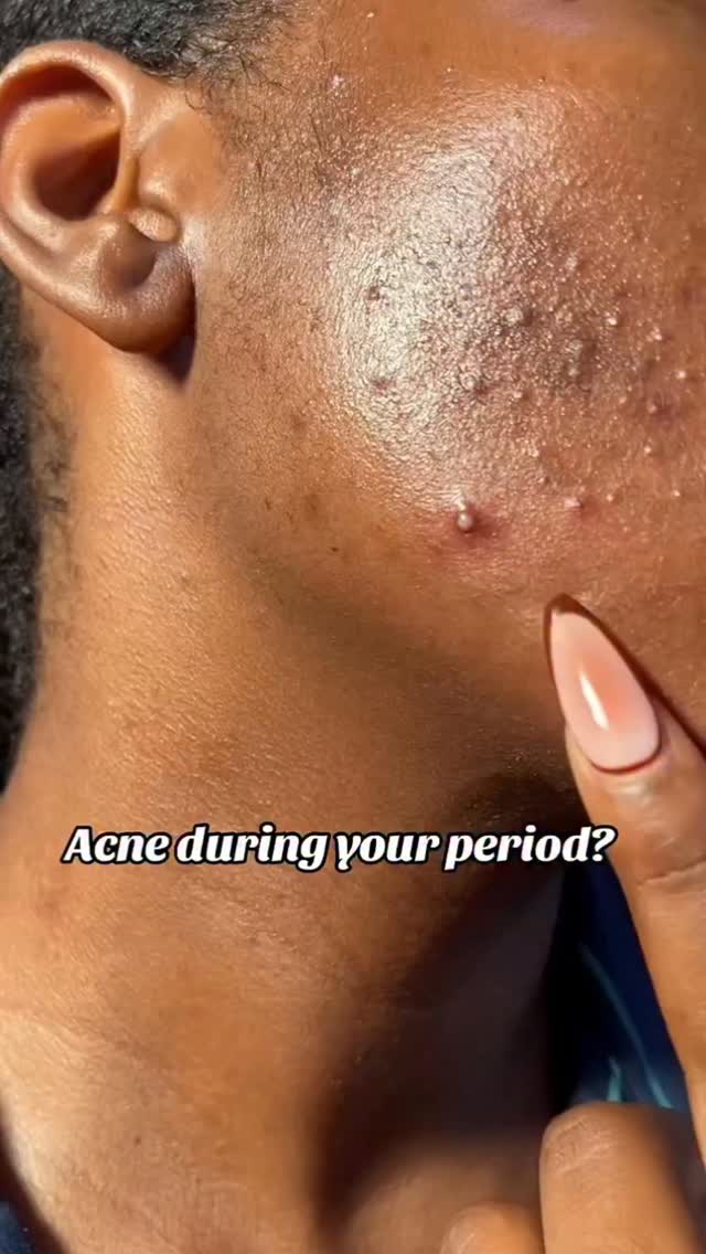 (Pimples)கொப்பளத்த கிள்ளாதீங்க❌@raviiiiii____ (கை கூட வைக்காதீங்க💯🍃+this product 👌
.
🌺 Comment 👉 Face , for link ✅
.
#skincare #instagram #explore #trending #reels