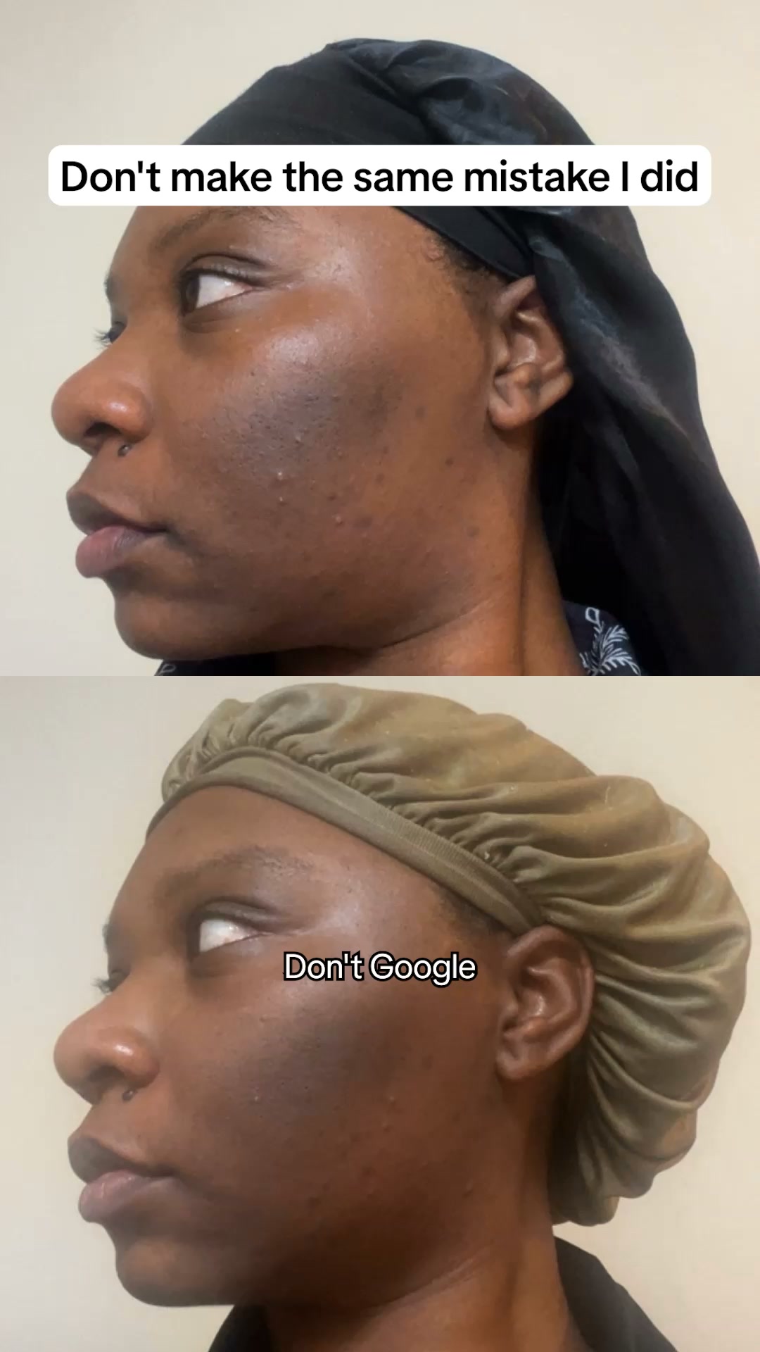 Fade The Appearance Hyperpigmentation for Just $12