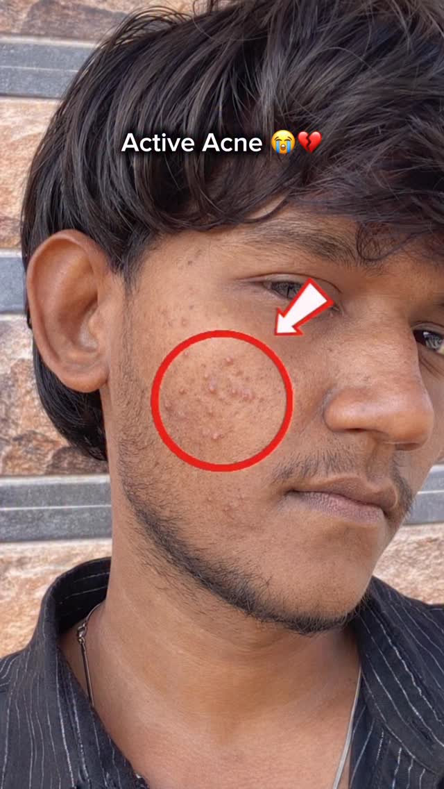 Comment “Dm” to get the product link 
#explore #acne #skincareroutine