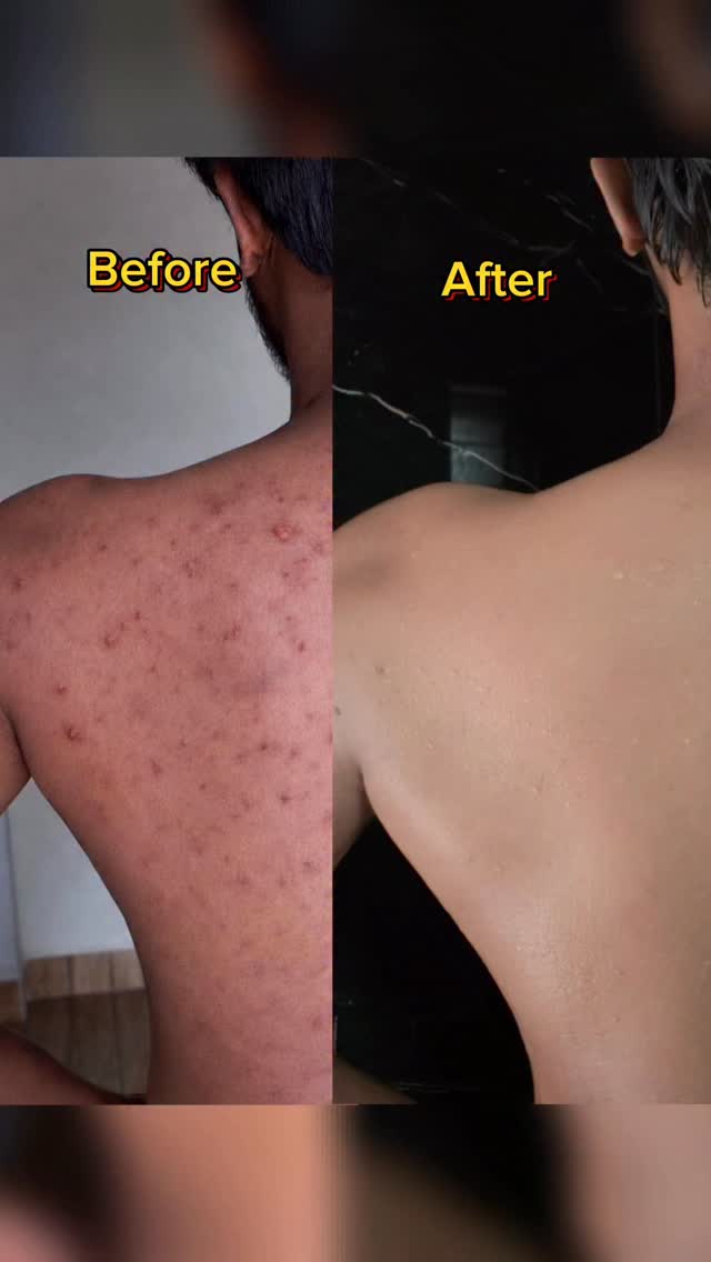 Bumpy skin & back acne? Not anymore! ✨

Using mCaffeine 2% Salicylic Acid Deo Body Wash 💙
Unclogs pores, controls oil & reduces acne — plus no body odour!

Fresh, smooth & confident all day 😍
Comment “LINK” 👇 
#explore #