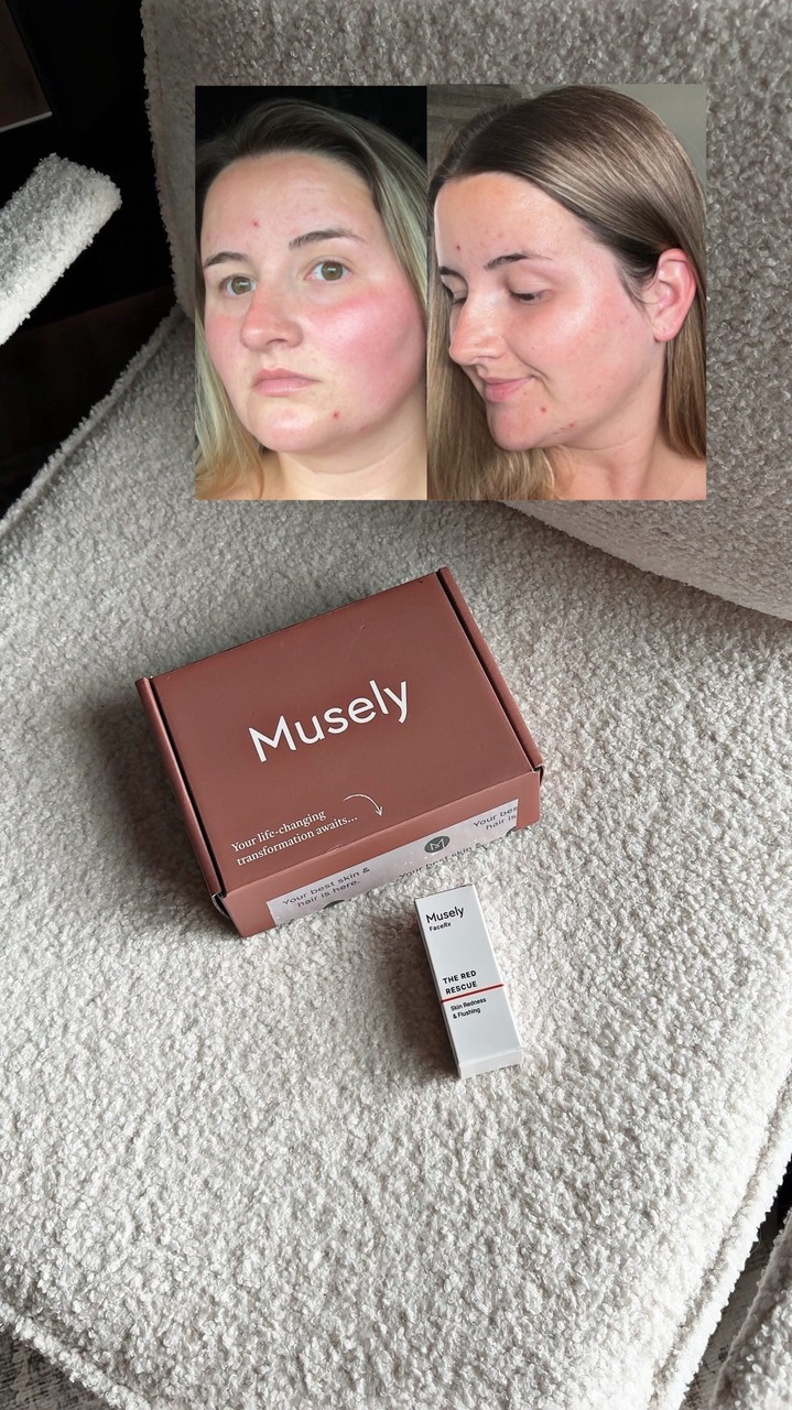I had to hold back happy tears looking in the mirror because my redness & irritation has never looked this diminished unless I’m wearing makeup 🥹 my high hopes were NOT disappointed! 🎉 Thank you @musely for sending me Th