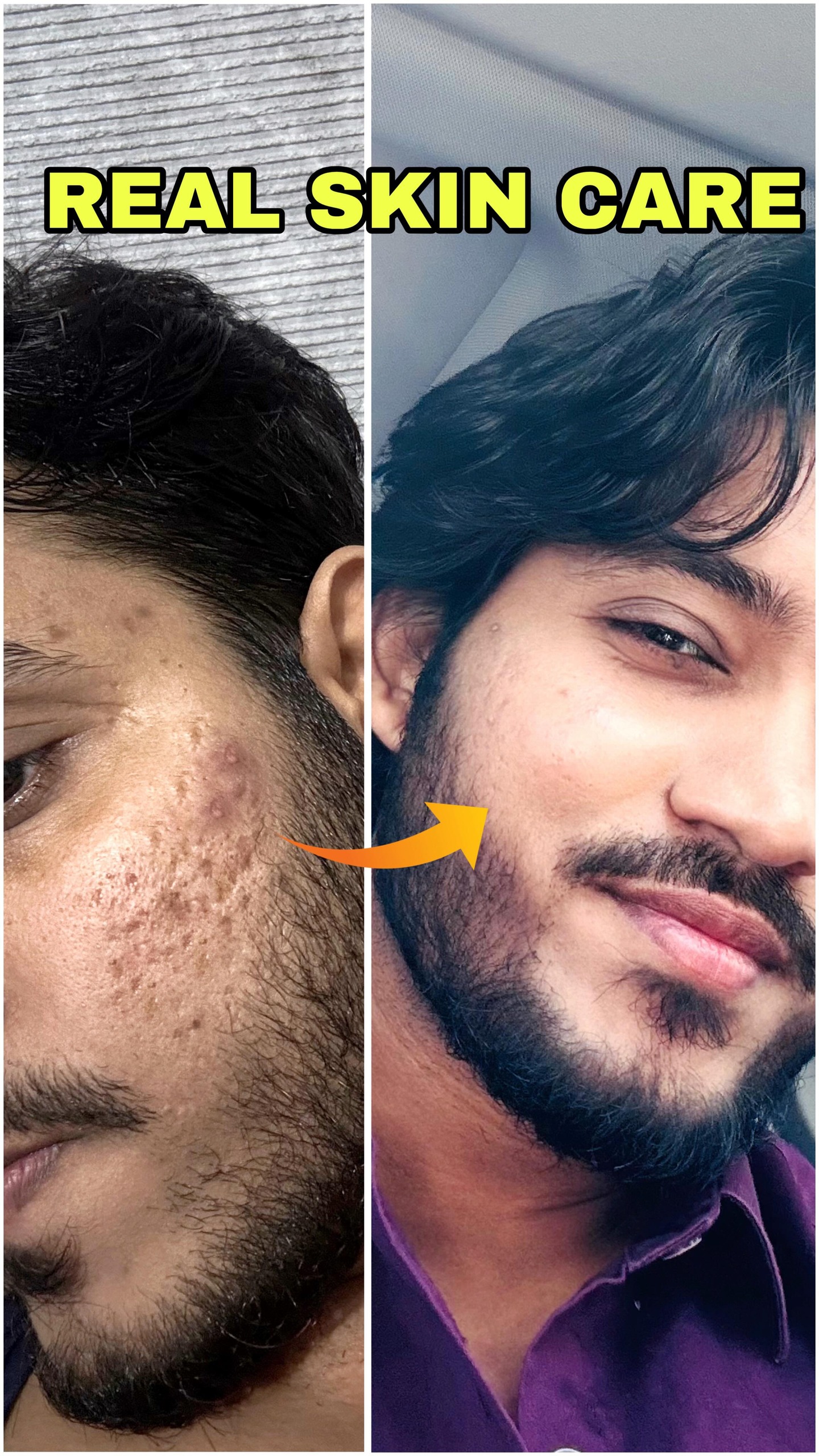 Comment “ glow “ to get link.

Agar galti se bhi aap yeh @hkvitals kaCollagen + Glutathione saath le lo 💥

Toh pigmentation, dark spots aur fine lines andar se repair hone lagte hain ✨

Morning mein HK Vitals Glutathione