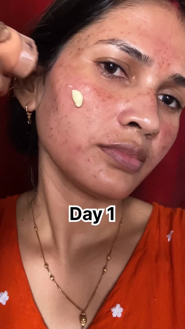 Follow & comment for link 🔗 @amazon 

#explorepage #viral #instagram #malasma #pigmentions
