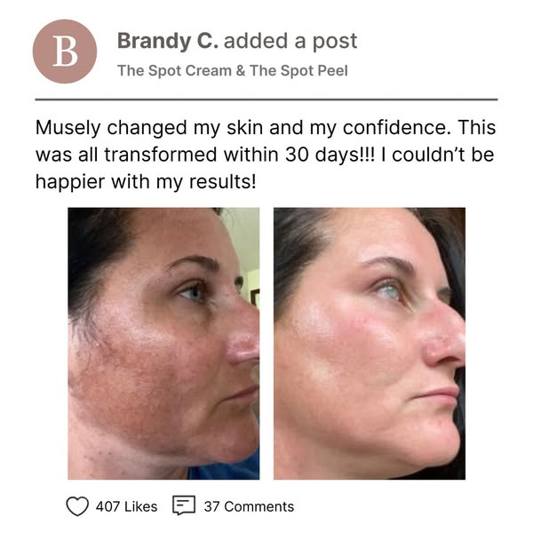 The holy-grail hyperpigmentation treatment combo that boosted Brandy's confidence: The Spot Cream & The Spot Peel! ✨ Join the community of more than 600,000 patients, and see incredible results in as little as 6 weeks!

