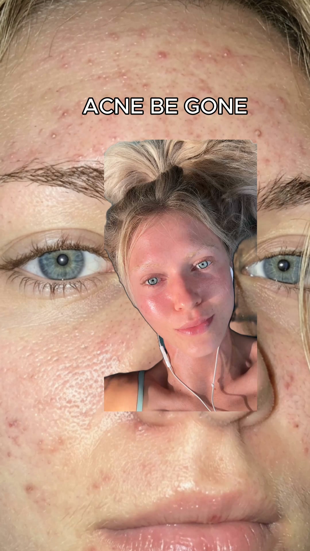 Results Or Your Money Back. Finally Stop Covering Up Your Breakouts With Makeup