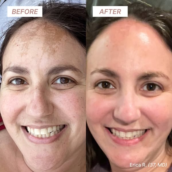 “My spots appeared during pregnancy and never went away. Just 60 days on Musely and I feel like a different person. No more being self-conscious, no more explaining, just a clear beautiful face!” - Erica

Watch your mela