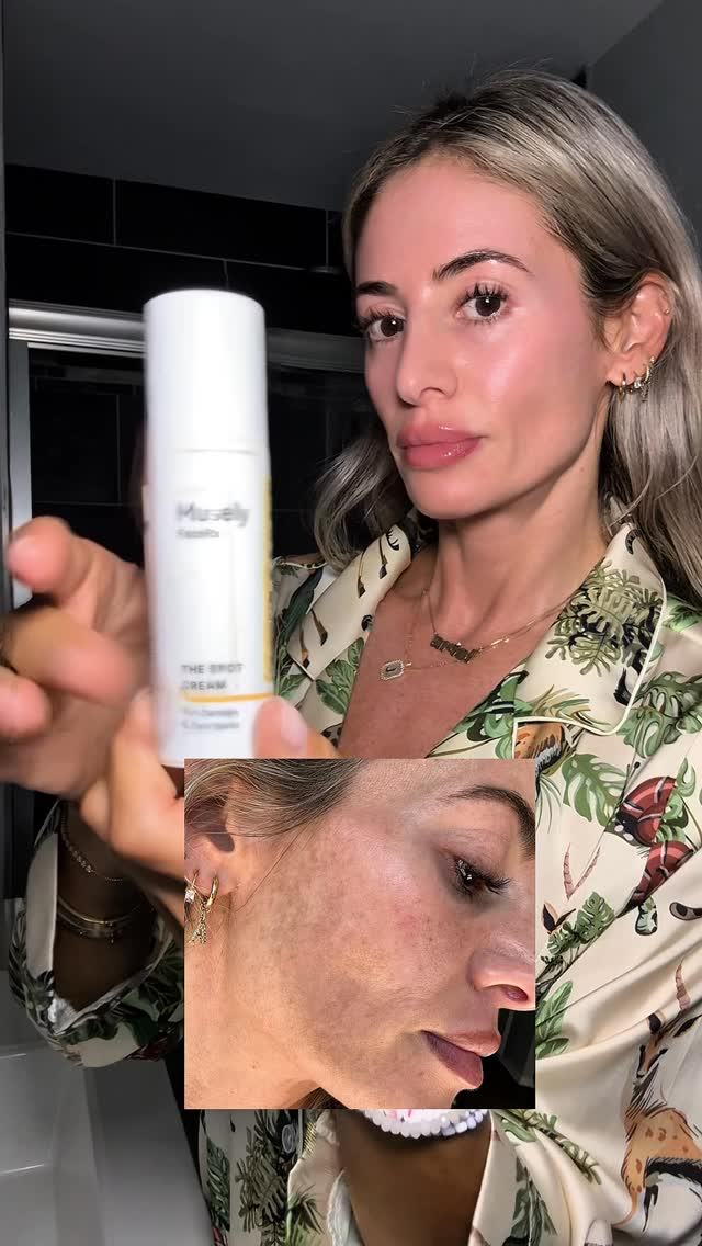 My melasma has nothing on the Spot Cream from @musely It’s been a journey but with consistency and the right product we’re getting there! 🙌🏼 #muselypartner #darkspots #hyperpigmentation #ad