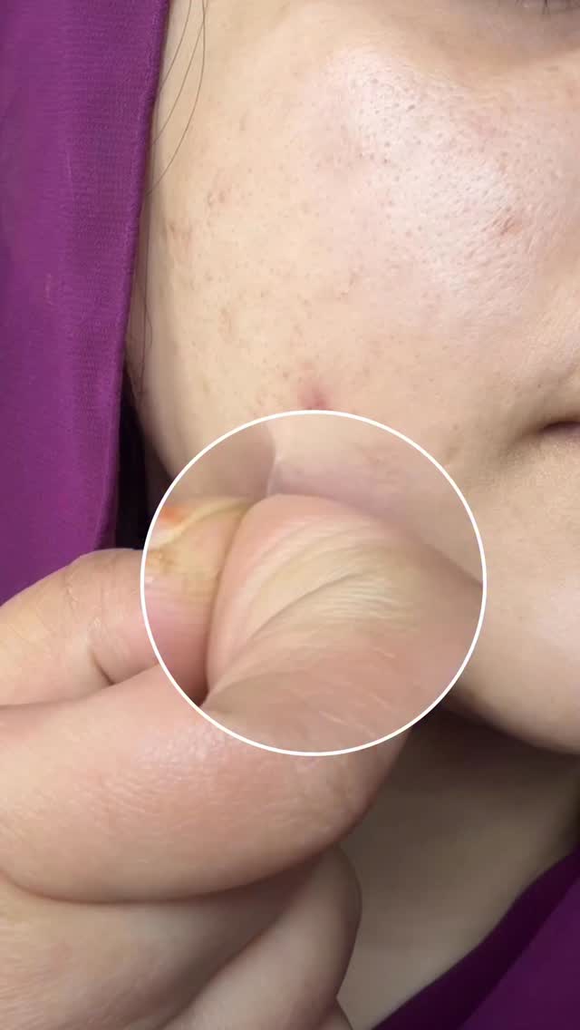 Comment for link 🔗 

Acne patch , inflammation acne , harmonal acne , pimples , redness