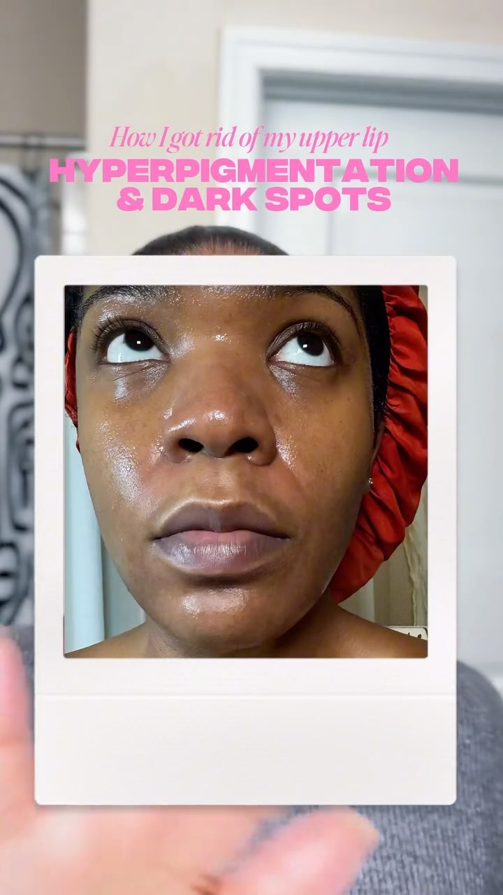 Hyperpigmentation/dark spots will do a number on your self esteem! So glad I found The Spot Cream from Musely. 

Get your confidence back today girl. 

@musely

#musely #darkspots #melasma #acnescars #hyperpigmentation #
