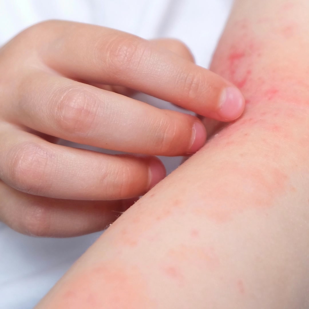 Restore and relieve atopic dermatitis symptoms with ceramide-rich, barrier-restoring skincare from CeraVe.