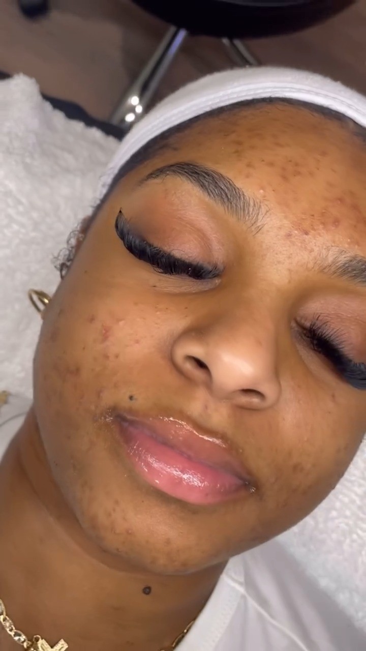 "Making you glow? That’s the way I like it! ✨💖 watching my clients’ transformations will never get old!

Clear and healthy skin isn’t achieved overnight. My client struggled with acne and wasn’t on a consistent skincare 