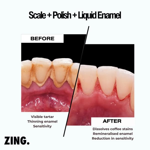 My dental hygienist recommended me this toothpaste to keep the stains away post-treatment!!