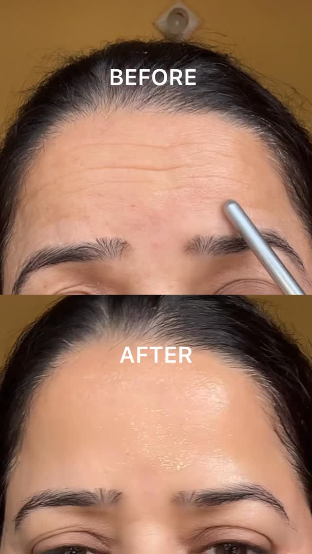 Comment down for the link! 🔗 
Fine lines wrinkles? Not anymore! With @drsheths Argireline® Peptide & Copper Peptide B’tox Serum 💚
.
.
.
.
dark spots, wrinkles, hyperpigmentation, anti aging cream
.
#antiaging #wrinkles #