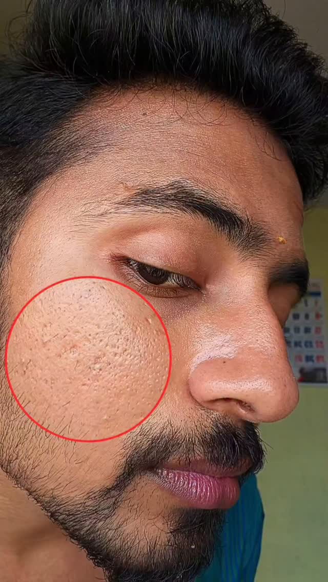 குழி குழியா pores🤧@raviiiiii____ (டாக்டர் recommend💯புதுசா try பன்னேங்க 🍃✨ 
.
 🌺Comment👉10, for link 🔗✅
.
🪄Benefits🍒
.
1.Controls over oil Secretion 👌
2.Minimize pores Size 💯
3.clears Darkspots, pigmentation 😻
4.Effectiv