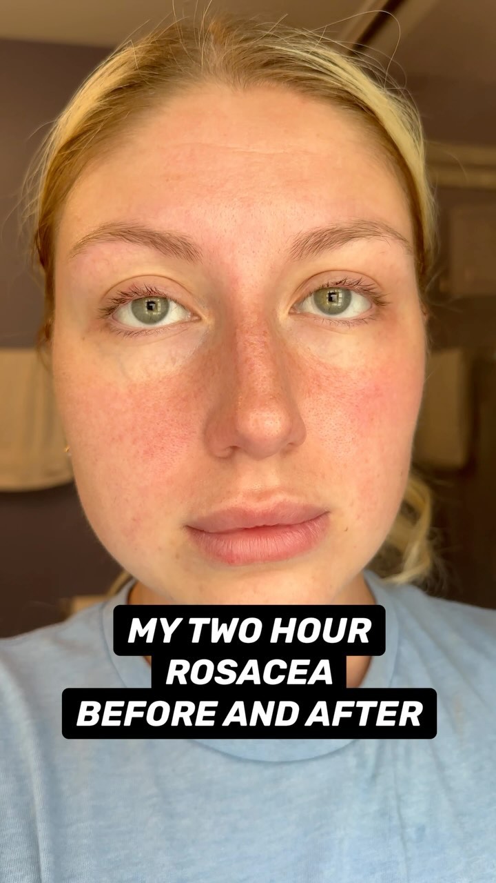 The transformation in my rosacea is actually insane! The Red Rescue by @musely is the secret I’ve been keeping from all of you! The Red Rescue is a fast acting prescription/RX rosacea treatment that’s great for calming f