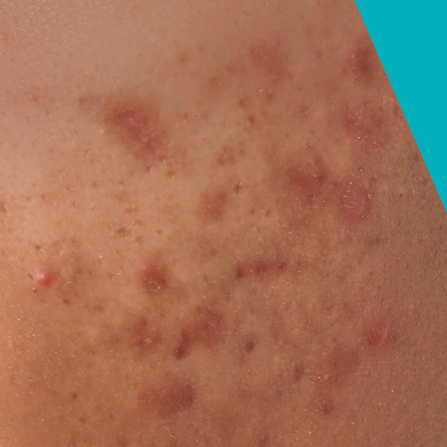 Restore the skin barrier and support Rx performance with ceramide-containing skincare from CeraVe.