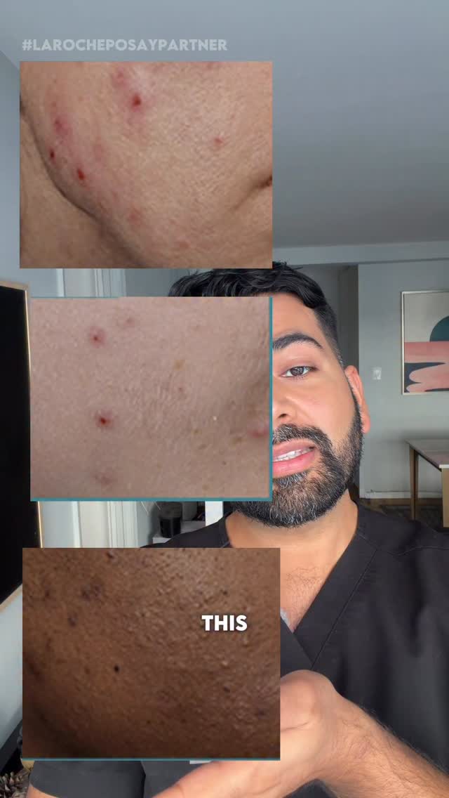 If your acne starts to act up when you least expect it (because obviously that’s how it goes…) DO NOT worry because @larocheposayusa did it again with their new Effaclar BPO! She gets to work with a micronized benzoyl pe